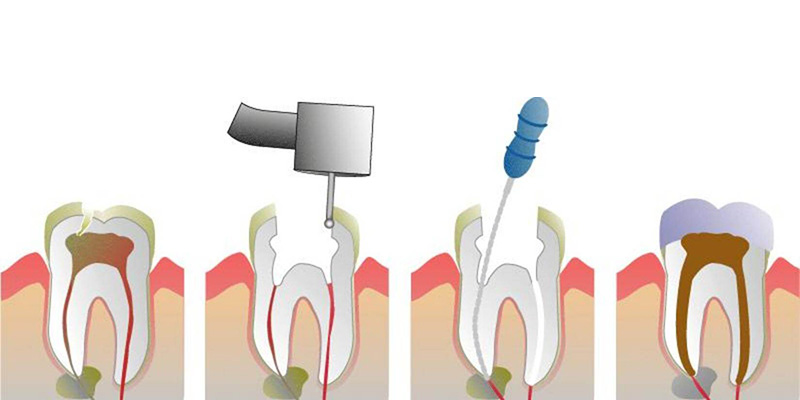 Root Canal Treatment