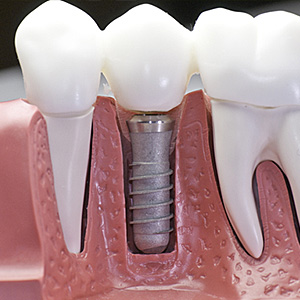 Dental Implants