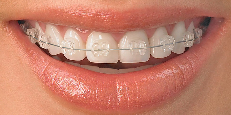 Orthodontic Treatment